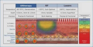 Khả năng nâng cơ của ultherapy