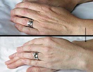 Trẻ hóa da bàn tay