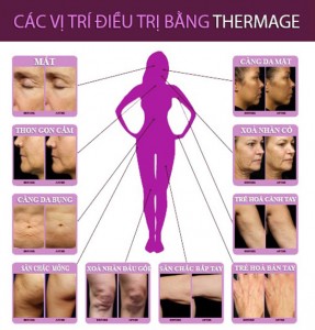 Các vị trí điều trị bằng Thermage